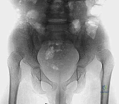 تفاصيل عملية بيمبرتون