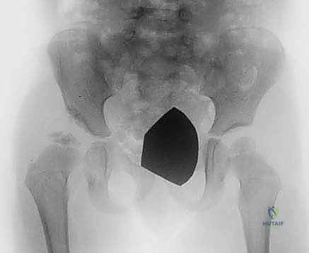 مراحل قطع العظم في بيمبرتون