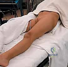 الأشعة السينية بعد بيمبرتون