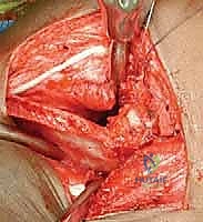 الرعاية المنزلية للطفل في الجبس