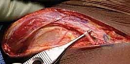 جراحات تصحيح تشوه مفصل الورك للأطفال (خلع الورك التطوري): تقنيات بيمبرتون وديجا