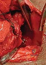 تنفيذ القطع العظمي بالدقة