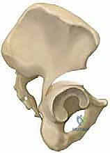 صورة توضيحية لـ جراحات تصحيح تشوه مفصل الورك للأطفال (خلع الورك التطوري): تقنيات بيمبرتون وديجا