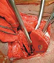 تنظيف التجويف الحقي