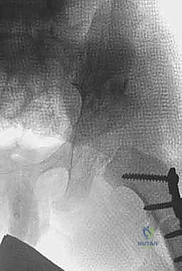 صورة توضيحية لـ جراحات تصحيح تشوه مفصل الورك للأطفال (خلع الورك التطوري): تقنيات بيمبرتون وديجا
