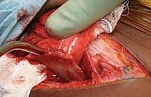 وضع الطعم العظمي النهائي