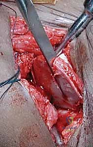 تطبيق الجبس البنطلوني