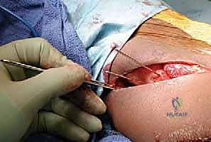 القطع العظمي في تقنية ديجا