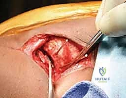 تشوه مفصل الورك وتأثيره على العظام