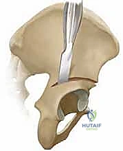 التخطيط الجراحي قبل العملية