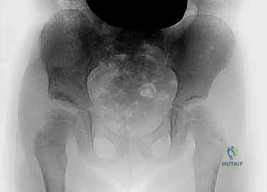 الرد المغلق والجبس البنطلوني