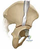 صورة توضيحية لـ جراحات تصحيح تشوه مفصل الورك للأطفال (خلع الورك التطوري): تقنيات بيمبرتون وديجا