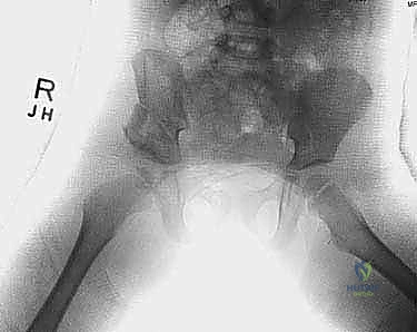 Illustration of pemberton and dega - Dr. Mohammed Hutaif