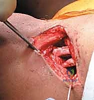 صورة شعاعية توضح خلع الورك