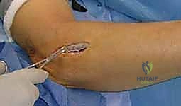 تحرير العصب الكعبري: دليل شامل لمتلازمة النفق الكعبري وعلاجها مع الأستاذ الدكتور محمد هطيف في صنعاء