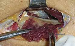 نقاط انضغاط العصب الكعبري في النفق الكعبري