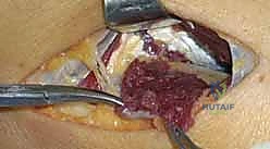 التشريح الدقيق للعصب الكعبري ومساره في الساعد