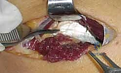 صورة توضيحية لـ تحرير العصب الكعبري: دليل شامل لمتلازمة النفق الكعبري وعلاجها مع الأستاذ الدكتور محمد هطيف في صنعاء