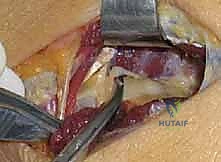 صورة توضيحية لـ تحرير العصب الكعبري: دليل شامل لمتلازمة النفق الكعبري وعلاجها مع الأستاذ الدكتور محمد هطيف في صنعاء