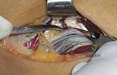 صورة توضيحية لـ تحرير العصب الكعبري: دليل شامل لمتلازمة النفق الكعبري وعلاجها مع الأستاذ الدكتور محمد هطيف في صنعاء