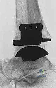 صورة طبية: استبدال مفصل الكاحل الكلي بنظامي سالتو وسالتو تالاريس: دليل شامل من الأستاذ الدكتور محمد هطيف