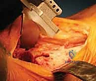 صورة طبية: استبدال مفصل الكاحل الكلي بنظامي سالتو وسالتو تالاريس: دليل شامل من الأستاذ الدكتور محمد هطيف