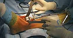 صورة تفصيلية لمكونات مفصل سالتو الكلاسيكي ذي المكون المتحرك