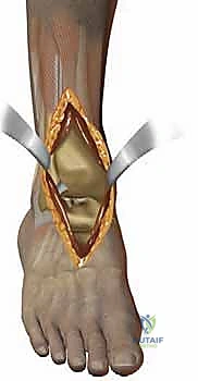 صورة توضيحية لـ استبدال مفصل الكاحل الكلي بنظامي سالتو وسالتو تالاريس: دليل شامل من الأستاذ الدكتور محمد هطيف