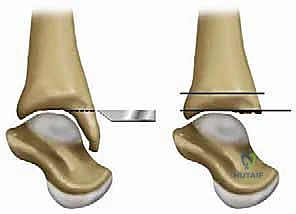 استبدال مفصل الكاحل الكلي بنظامي سالتو وسالتو تالاريس: دليل شامل من الأستاذ الدكتور محمد هطيف