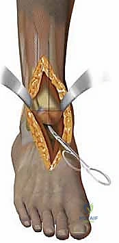 صورة توضيحية لـ استبدال مفصل الكاحل الكلي بنظامي سالتو وسالتو تالاريس: دليل شامل من الأستاذ الدكتور محمد هطيف