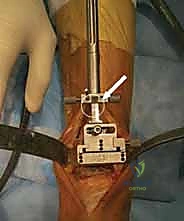 صورة توضيحية لـ استبدال مفصل الكاحل الكلي بنظامي سالتو وسالتو تالاريس: دليل شامل من الأستاذ الدكتور محمد هطيف