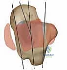 مريض يعاني من ألم شديد في الكاحل أثناء محاولة المشي