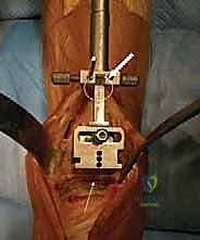 صورة توضيحية لـ استبدال مفصل الكاحل الكلي بنظامي سالتو وسالتو تالاريس: دليل شامل من الأستاذ الدكتور محمد هطيف