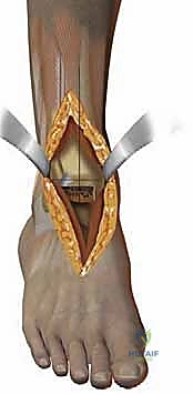 صورة طبية: استبدال مفصل الكاحل الكلي بنظامي سالتو وسالتو تالاريس: دليل شامل من الأستاذ الدكتور محمد هطيف