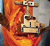 صورة طبية: استبدال مفصل الكاحل الكلي بنظامي سالتو وسالتو تالاريس: دليل شامل من الأستاذ الدكتور محمد هطيف