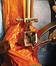 صورة طبية: استبدال مفصل الكاحل الكلي بنظامي سالتو وسالتو تالاريس: دليل شامل من الأستاذ الدكتور محمد هطيف