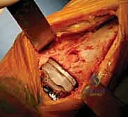 صورة توضيحية لـ استبدال مفصل الكاحل الكلي بنظامي سالتو وسالتو تالاريس: دليل شامل من الأستاذ الدكتور محمد هطيف