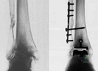 صورة طبية: استبدال مفصل الكاحل الكلي بنظامي سالتو وسالتو تالاريس: دليل شامل من الأستاذ الدكتور محمد هطيف