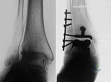 صورة طبية: استبدال مفصل الكاحل الكلي بنظامي سالتو وسالتو تالاريس: دليل شامل من الأستاذ الدكتور محمد هطيف