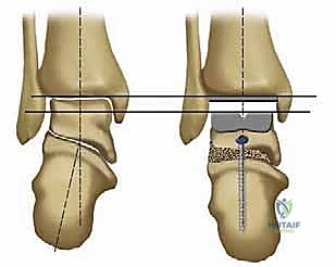 صورة طبية: استبدال مفصل الكاحل الكلي بنظامي سالتو وسالتو تالاريس: دليل شامل من الأستاذ الدكتور محمد هطيف