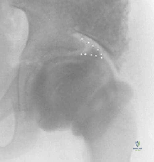 جراحة دعم الشفا (الرفرف) لمرض بيرثيز: حل دائم لمشاكل مفصل الفخذ لدى الأطفال مع الأستاذ الدكتور محمد هطيف