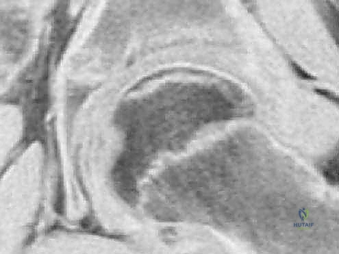 صورة شعاعية توضح مراحل تطور مرض بيرثيز