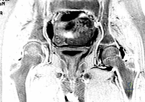 تحديد موقع الشق الجراحي بدقة