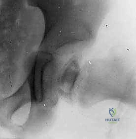 تشكيل الرفرف العظمي فوق التجويف الحقي