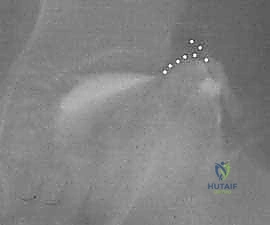 استخراج الطعم العظمي وتجهيزه