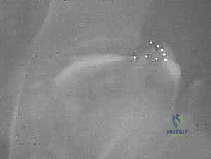 صورة توضيحية لـ جراحة دعم الشفا (الرفرف) لمرض بيرثيز: حل دائم لمشاكل مفصل الفخذ لدى الأطفال مع الأستاذ الدكتور محمد هطيف