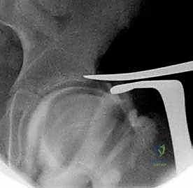 متابعة التئام الجرح في الأسابيع الأولى