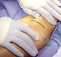 تثبيت الطعم العظمي لضمان الاستقرار