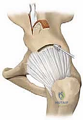 صورة شعاعية بعد التثبيت المباشر