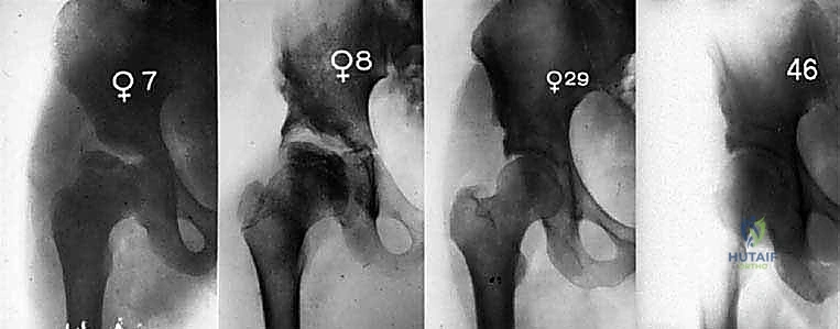 صورة تظهر النتيجة النهائية لاستقرار المفصل